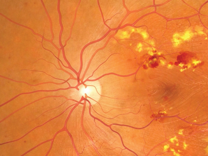 diabeticretinopathy_video1