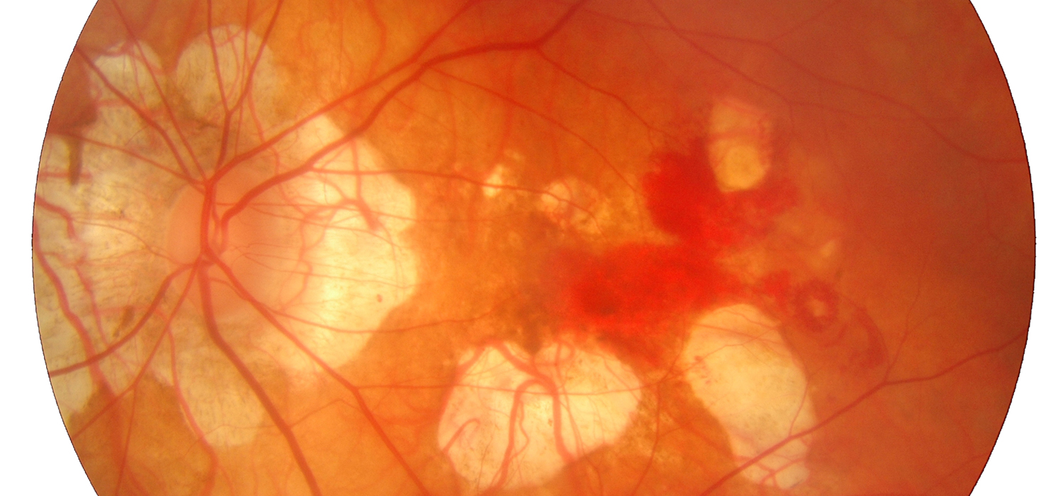 Midwest Eye Consultants