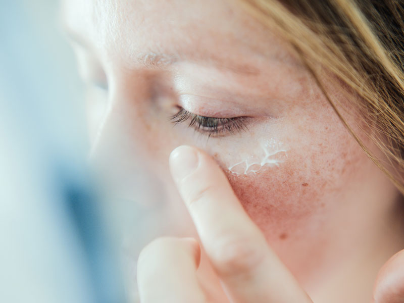 The Surprising Skin Conditions That Could Be Behind Your Dry Eye