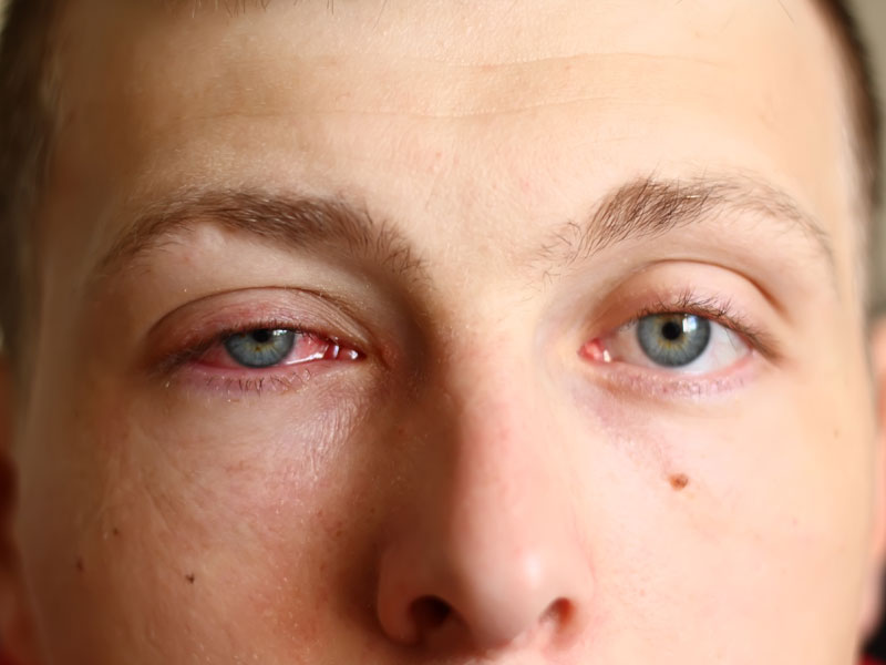 The Scoop on Pink Eye: Prevention, Risk Factors & Treatments